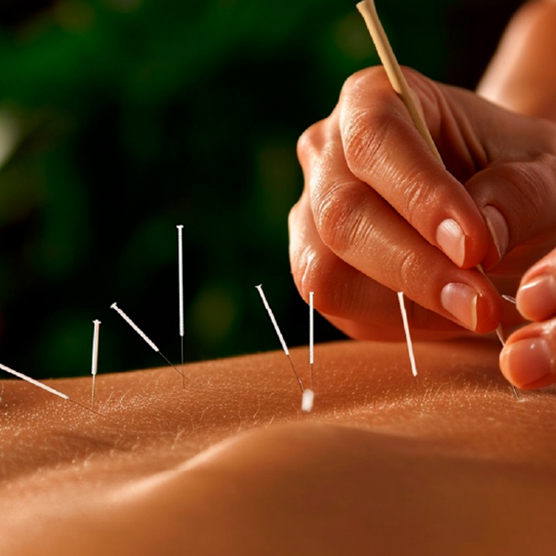 Acupuntura