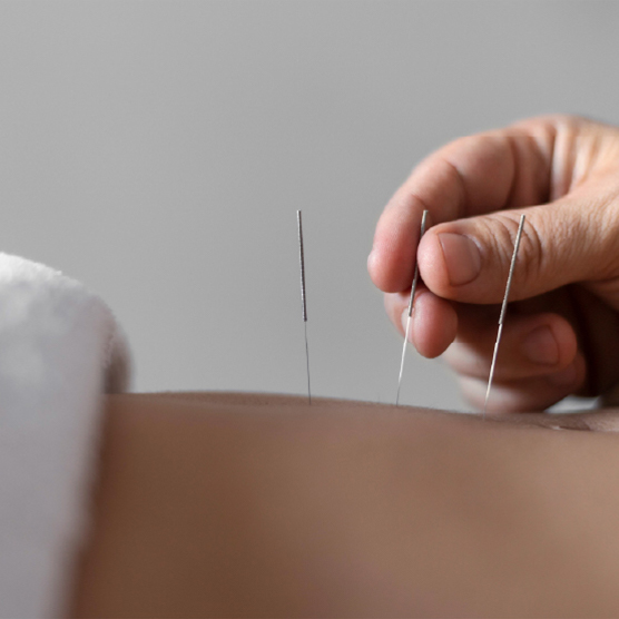 Acupuntura